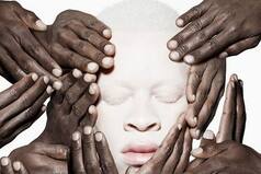 International Albinism Awareness Day 2020: History, Significance of The Day And Theme For This Year