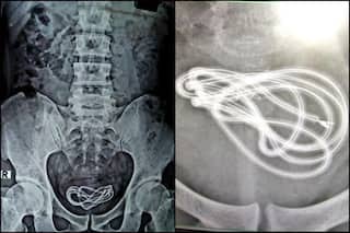 'His Mental Health Remains a Question': Doctor Finds Mobile Charger in Guwahati Man's Bladder After he Masturbated