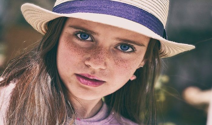 How To Remove Freckles Permanently And Get Spotless Skin