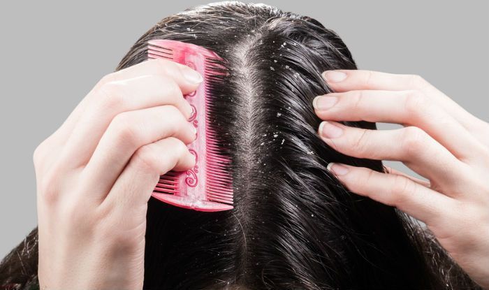 Hair Care How To Get Rid Of Chronic Dandruff