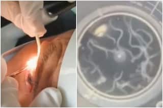 Yikes! Doctor Removes 20 Live Worms From 60-Year-Old Chinese Man   s Eyelid