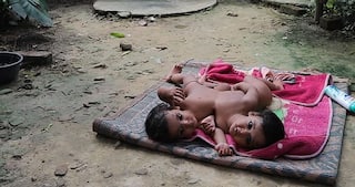 Remember UP's Conjoined Twins? They Have Been Separated After 9-Hour-Surgery at Lucknow   s KGMU