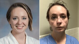 US Nurse Shares Before & After Pictures of Herself to Show Toll of Treating Coronavirus