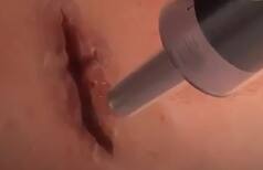 Imagine A Glue That Heals Deep Cuts or Wounds Instantly. It's Coming! | Watch Video
