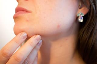 PCOS And Acne: Here Are Expert-Approved Skincare Tips