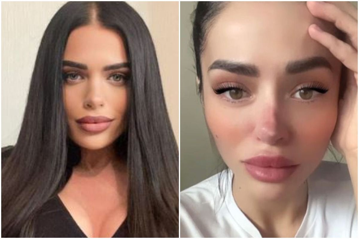 nose job gone wrong before and after