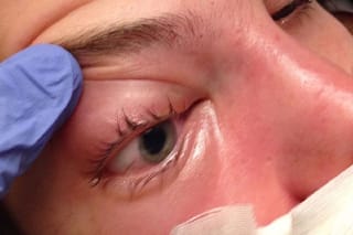 मुंबई में सामने आया ब्लैक फंगस का खतरनाक मामला, 3 बच्चों को गंवानी पड़ी अपनी आंख