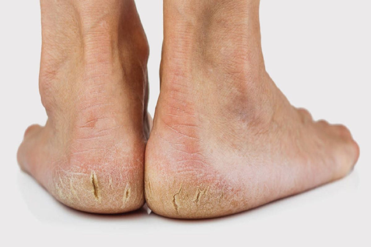 Top remedies for treating cracked heels - SynxBody