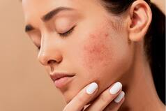 Skincare: Essential Tips to Protect Your Skin This Monsoon