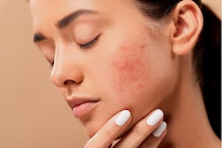 Acne-Prone Skin? 6 Skincare Ingredients You Should Avoid
