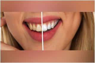 7 Food Items Responsible for Causing Yellow Teeth And Why You Should STOP Having Them Right Away!