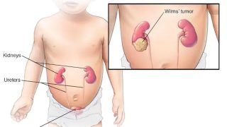Wilms Tumour: Symptoms, Causes, And Treatment of This Kidney Cancer in Children