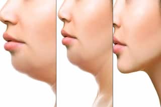 5 Most Effective Yoga Asanas to Get Rid of Double Chin