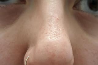 5 Easy-to-Follow Natural Remedies to Cure Open Pores