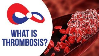 World Thrombosis Day 2021 : Thrombosis, Symptoms, Treatment Explained | Watch Video