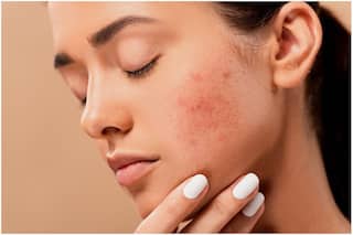 Summer Skincare: Struggling With Sweat-Induced Acne? 5 Ayurvedic Tips to Prevent it