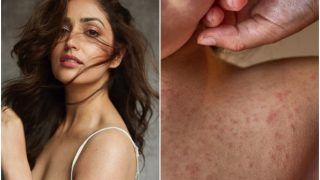 What is Keratosis Pilaris, The Skin Condition That Yami Gautam is Suffering From