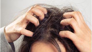 Haircare Tips: 7 Ayurveda Solutions to Get Rid of Dandruff Instantly