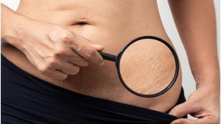 5 Natural Ways to Get Rid Of Stretch Marks