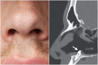 Man Who Had Trouble Breathing Discovers That a Tooth Was Growing Inside His Nose!
