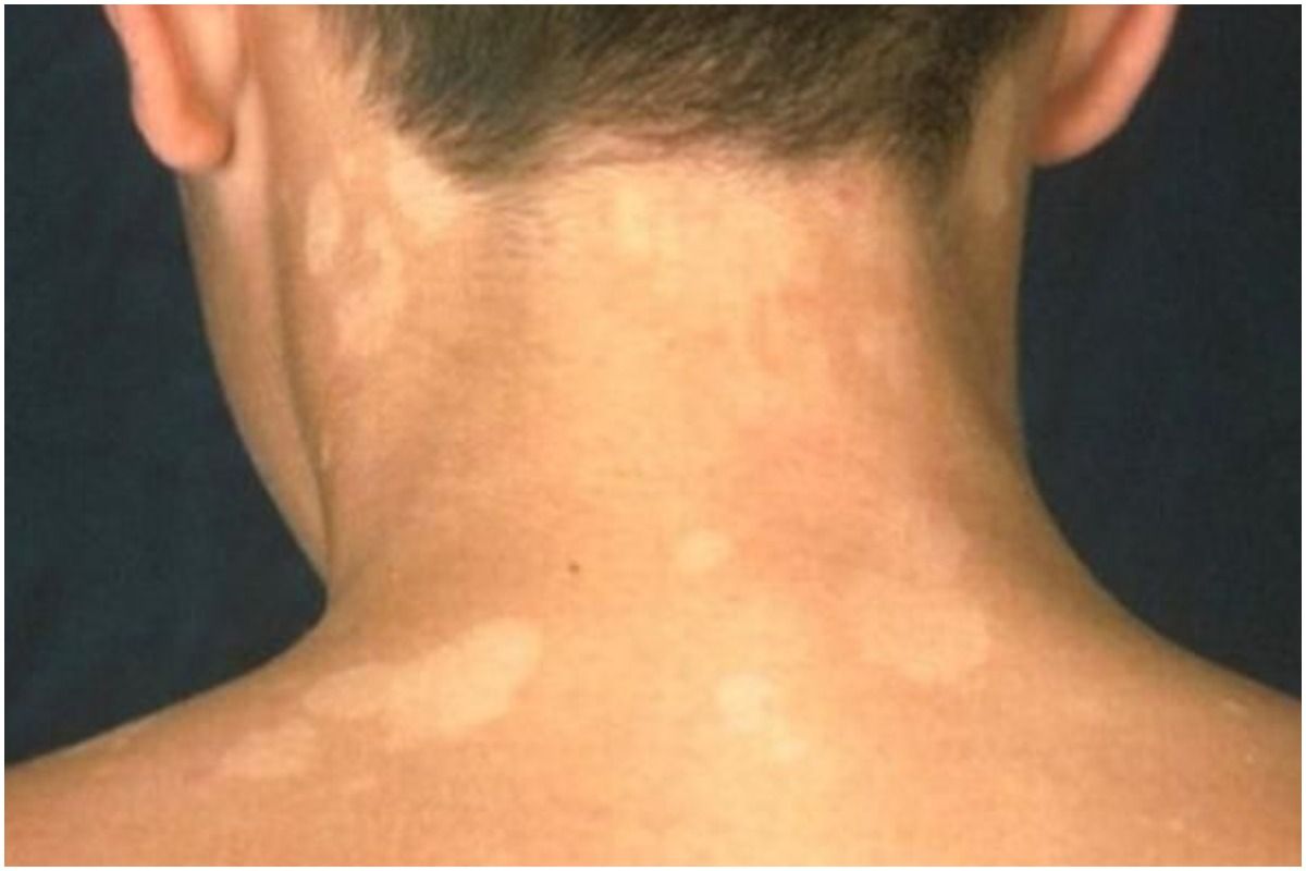 tinea versicolor before and after