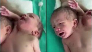 MP Hindi News: मध्य प्रदेश के रतलाम में अनोखे शिशु का जन्म, एक ही धड़ से जुड़े हैं दो सिर और तीन हाथ