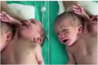 MP Hindi News: मध्य प्रदेश के रतलाम में अनोखे शिशु का जन्म, एक ही धड़ से जुड़े हैं दो सिर और तीन हाथ