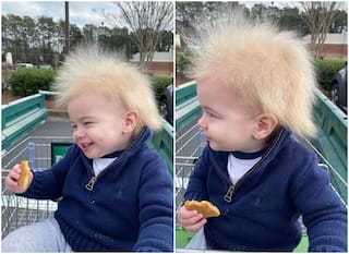 What is 'Uncombable Hair Syndrome', Rare Genetic Condition That This Toddler Was Born With?