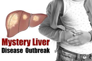 Kids At Risk: WHO Warns of Acute Hepatitis Affecting Liver. CDC Asks Docs To Report Cases