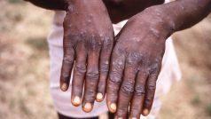 Monkeypox को लेकर यूपी में जारी की गई एडवायजरी, जानें क्या हैं इस बीमारी के लक्षण