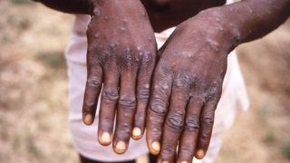 Monkeypox: Rajasthan Govt Issues Advisory For Passengers Travelling From These Countries | Full List Here