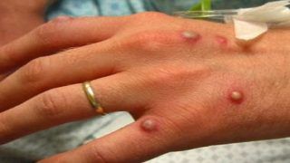 Monkeypox से संक्रमित लोगों को रहना होगा क्वारंटीन, बेल्जियम में लागू हुआ नियम
