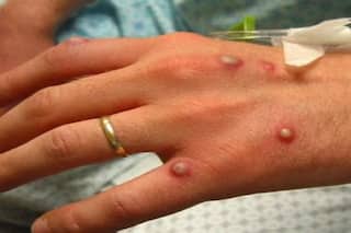 Monkeypox Virus Cases Confirmed in 14 Countries So Far. Full List Here