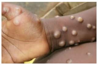 क्या Monkeypox ने भारत में दे दी है दस्तक? इस राज्य में मिला संदिग्ध मरीज