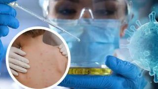 Monkeypox Scare in India: Mumbai Civic Body Readies Isolation Ward in Hospital, Issues Advisory