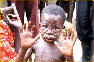 Monkeypox In India: बच्चों के लिए खतरनाक हो सकता है मंकीपॉक्स, बुखार के साथ चकत्ते हों तो जरूर जांच कराएं