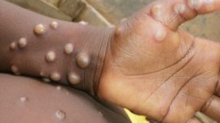 Monkeypox Virus: यूरोप में तेजी से बढ़ रहे हैं मंकीपॉक्स के मामले, WHO ने बुलाई आपात बैठक, जानिए कितना है खतरनाक...