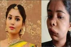 Kannada Actor Swathi Sathish's Root Canal Surgery Goes Wrong, Suffers Swollen Face And Massive Pain