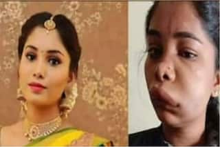 Kannada Actor Swathi Sathish's Root Canal Surgery Goes Wrong, Suffers Swollen Face And Massive Pain