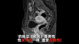 Chinese Man With Urinary Problem Discovers He Has Ovaries And Uterus. Read What Happened Next