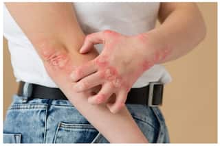 Diabetes And Skin Problems: 5 Expert-Backed Tips on How to Prevent Skin Issues in Diabetes