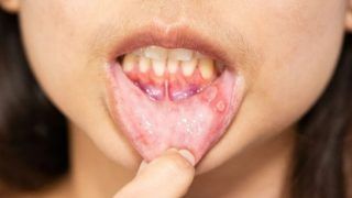 Mouth Ulcers: 5 Home Remedies to Treat Painful Canker Sores Naturally