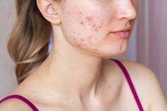 Tired of Acne-Prone Skin? 10 Magical Ingredients For Acne-Free Monsoon