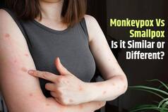 Monkeypox or Smallpox: Is It Similar or Different? Here's What You Should Know