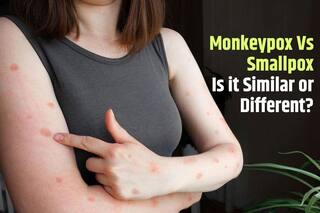Monkeypox or Smallpox: Is It Similar or Different? Here's What You Should Know