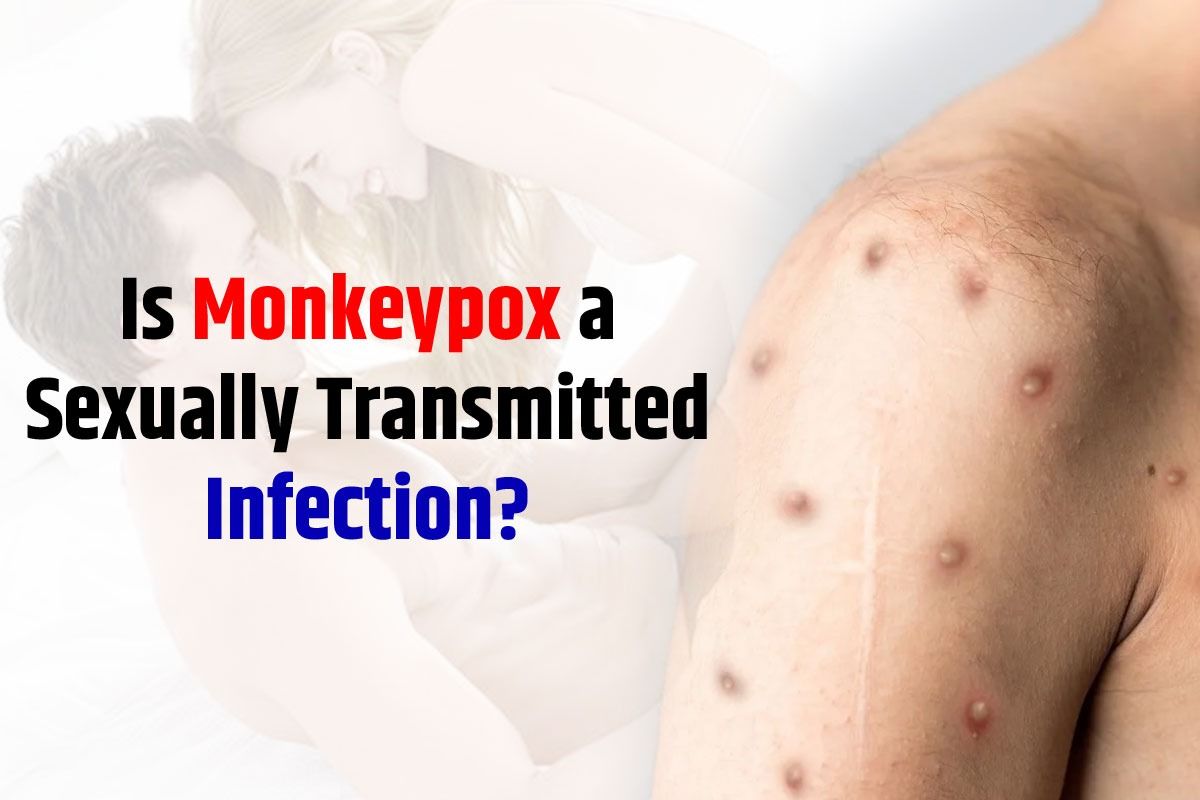 Can You Contract Monkeypox Through Sex, Heres What Expert Has to