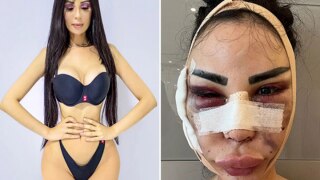 Model Splurges Rs 4.7 Crores to Look Like Kim Kardashian, Regrets It & Spends 95 Lakh to 'Detransition' | See Pics