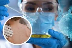 Monkeypox Scare: Task Force To Be Set Up To Provide Guidance To Govt On Tackling Virus Spread