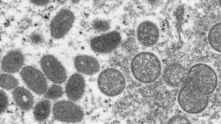 US Health Officials Confirm 2 Cases Of Monkeypox In Children