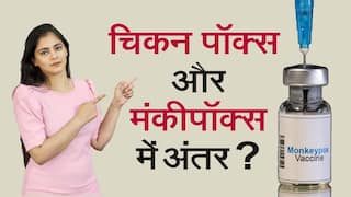 Monkeypox vs Chickenpox: मंकीपॉक्स के लक्षण क्या है और चिकन पॉक्स और मंकीपॉक्स में अंतर | Watch Video